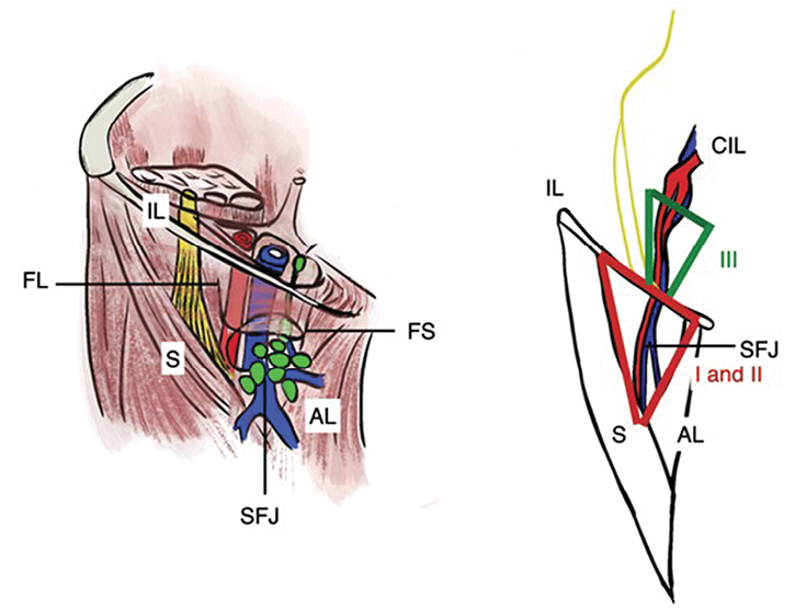 Case Report Video Endoscopic Inguinal And Simultaneous Pelvic Lymph